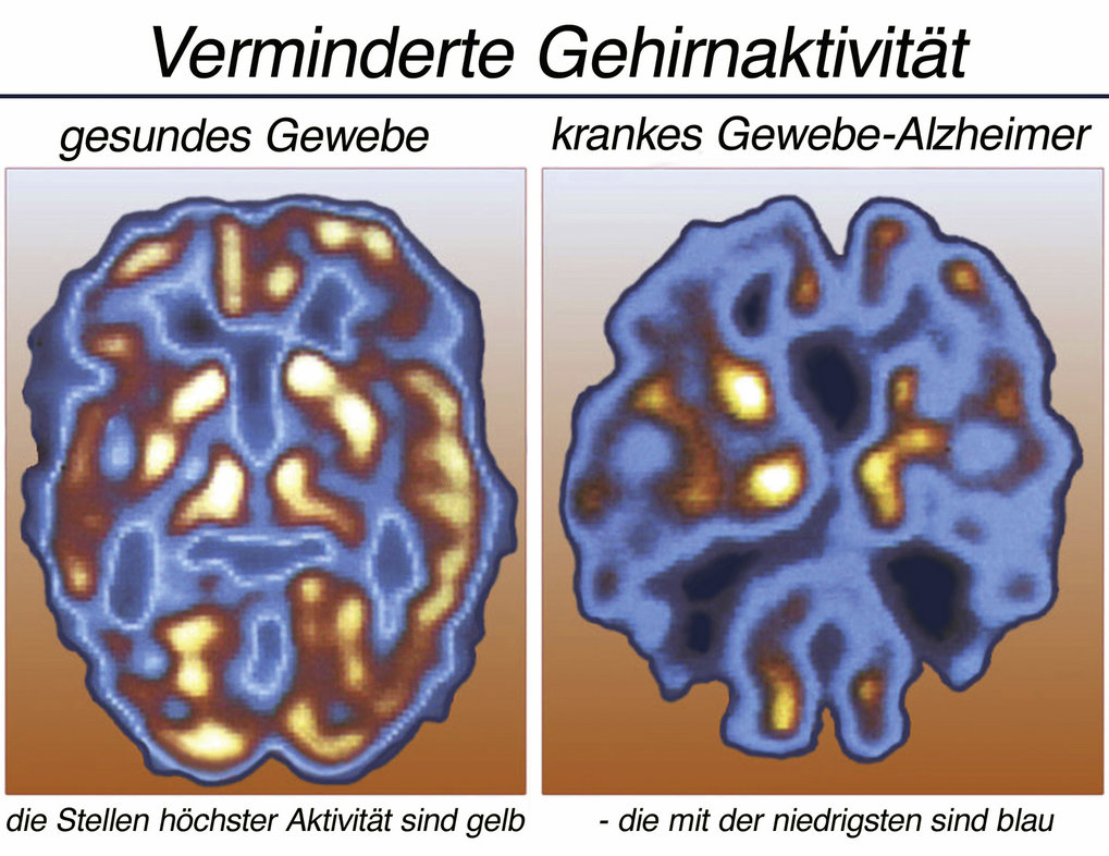 Alzheimer: Protein-Klumpen Im Gehirn | Max-Planck-Gesellschaft