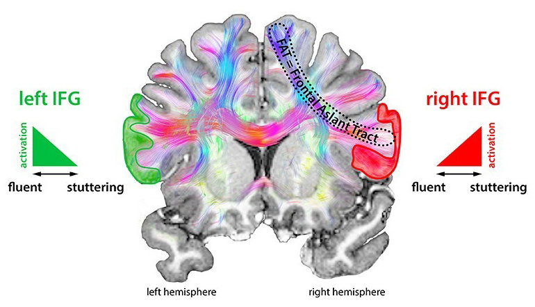 stuttering-stop-signals-in-the-brain-prevent-fluent-speech-max