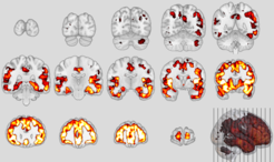 Neuroanatomische Muster der behaviouralen Variante der frontotemporalen Demenz (oben) und der Schizophrenie 