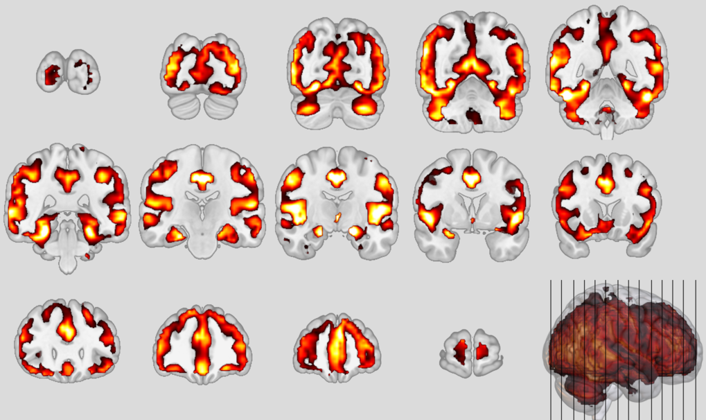 frontotemporal dementia Archives - TrendRadars UK