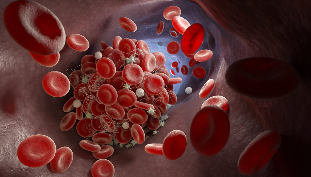 Schematic representation of the formation of a blood clot in a vein.