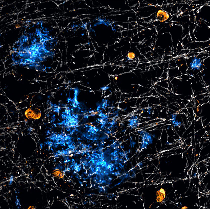 Not only neurons build the protein amyloid beta (blue), which clumps together and forms harmful plaques in Alzheimer's disease: Special glial cells of the brain - the oligodendrocytes (orange) - also produce such deposits. Myelin, which insulates neurons, is stained white.