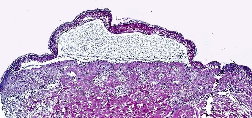 Epidermal detachment by toxic Epidermal Necrolysis. 