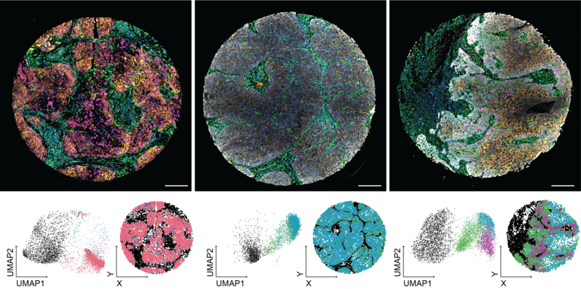 Patient biopsies that have been stained with a panel of fluorescent antibodies (upper panels). Extraction of fluorescence intensities along with morphological features of cells and tissue allows extraction of a multiparameter description of each cell in the tissue (lower left; each dot in the panel represents a single cell) and grouping these cells based on their similarity generates a patient-specific fingerprints (lower right panel).