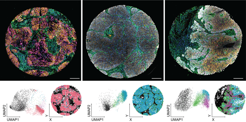 Multi-panel microscopic image analysis. The top row displays three circular, high-resolution images, presumably of a tissue section. Each circle likely represents an identical tissue sample, likely stained and viewed under a microscope. The colors within each circular image are varied and represent different cellular components or marker expression patterns. The middle row shows three sets of two-dimensional plots (UMAP1 vs. UMAP2). These plots visually group and arrange the data points from the corresponding image in the top row. The data points vary in color. The color schemes within each plot likely correspond to the color schemes in the matching image above, thus providing a visual correlation of spatial location to cellular identity within the larger tissue sample.  The axes are labeled (X and Y) with the axis labels UMAP1 and UMAP2. These UMAP plots effectively reduce and represent the high-dimensionality of multiple markers into a more readily visualizable two-dimensional space. The overall image suggests an analysis workflow where detailed microscopic images of a tissue section are processed to identify and cluster distinct cell types based on various markers. The color-coded representation in the microscopic images, and the scatter plots help in classifying the cells present in the image.