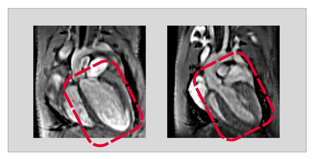 Low USP5 concentration leads to heart muscle weakness. The figure shows images of hearts using magnetic resonance imaging (MRI). While the heart of the control animal (right) is healthy in terms of size and thickness of the heart wall, a low USP5 concentration leads to dilatation of the heart and muscle weakness (dilated cardiomyopathy, left).