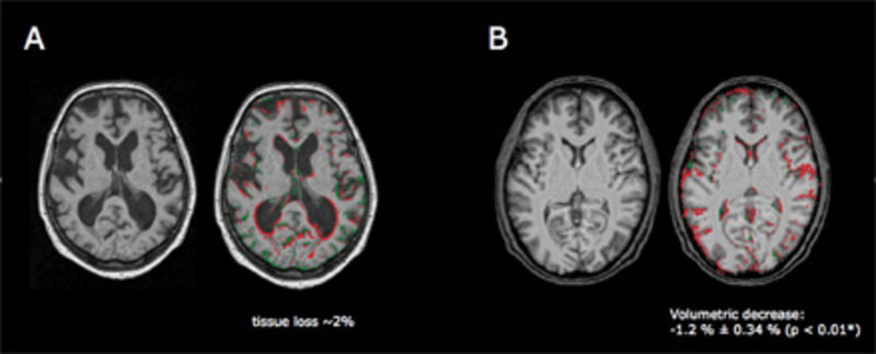 Alzheimer mrt befund