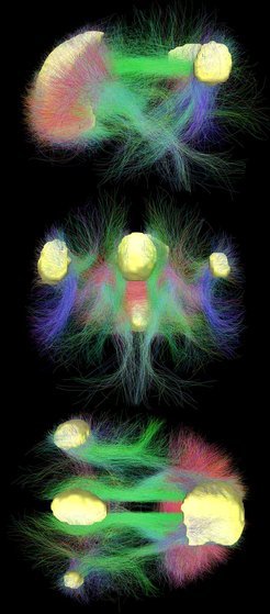 A daydreaming brain: the yellow areas depict the&nbsp;default mode network from three different perspectives; the coloured fibres show the connections amongst each other and with the remainder of the brain.